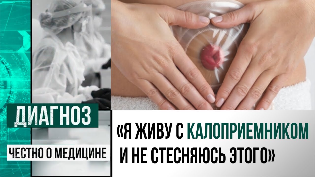 Стома &ndash; не приговор: как жить, если удалён кишечник? | Диагноз