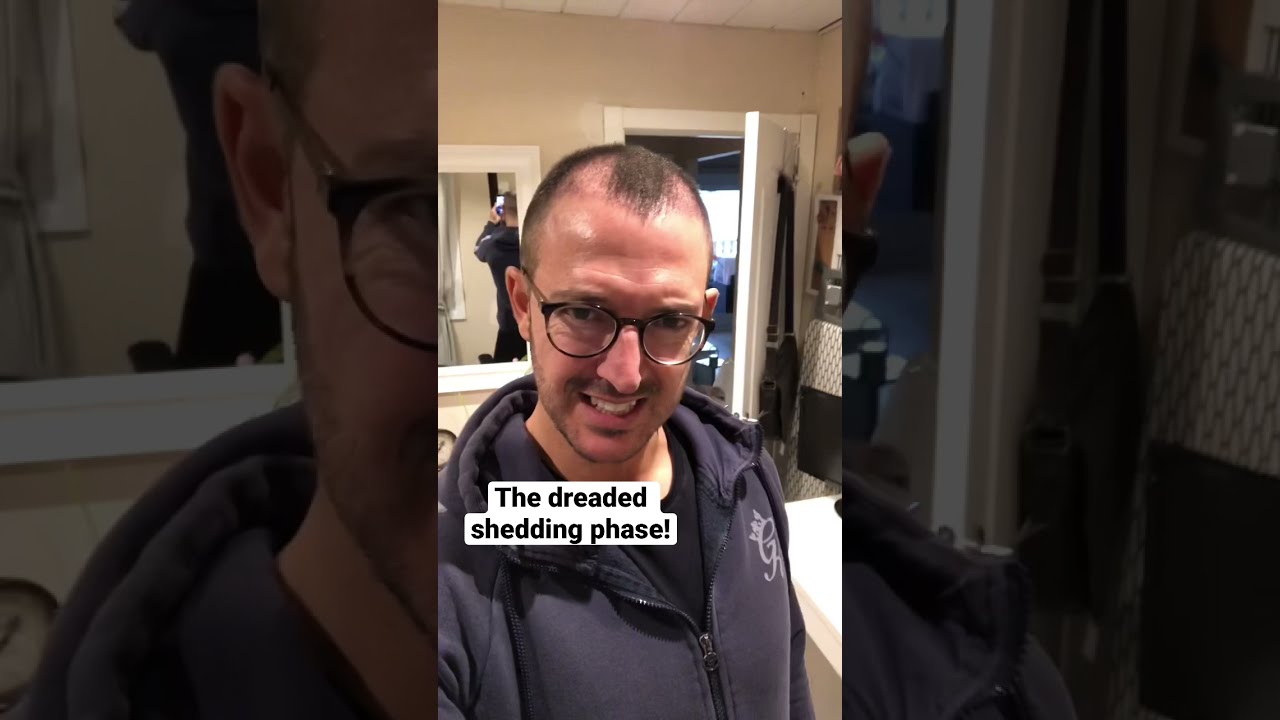 The dreaded shedding phase of a hair transplant!!