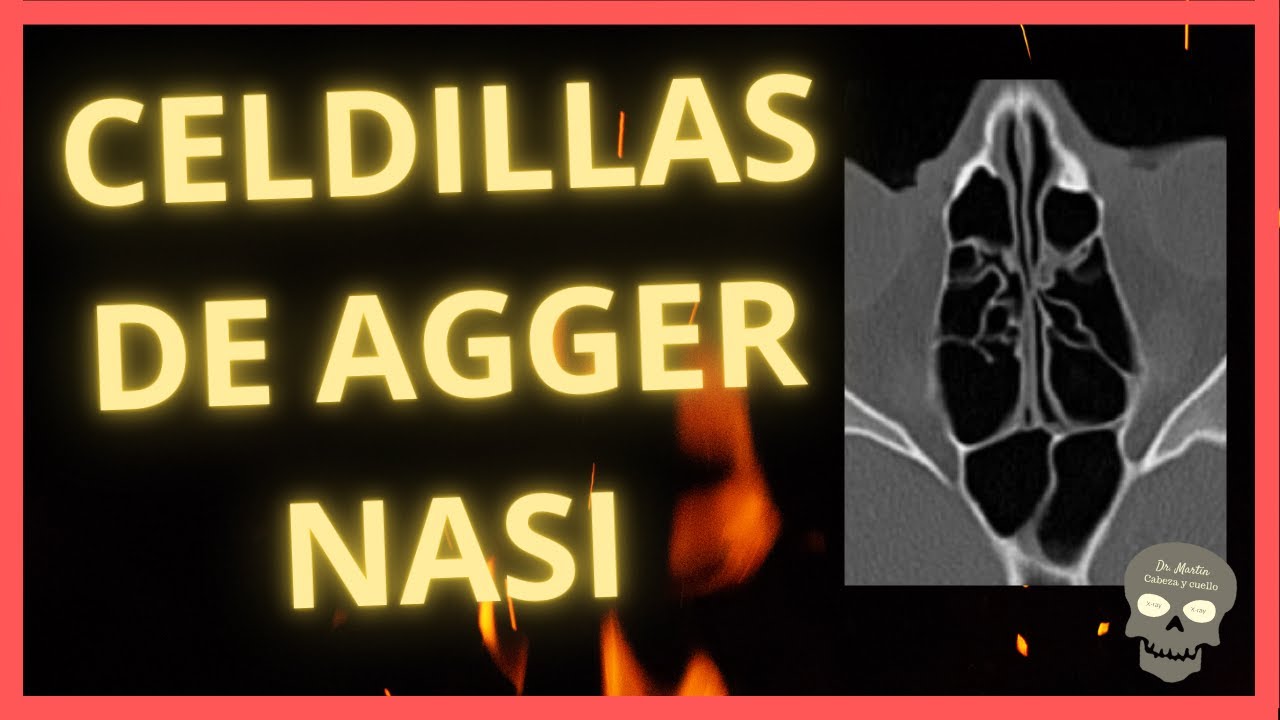 Celdillas de AGGER NASI👉En Tomograf&iacute;a