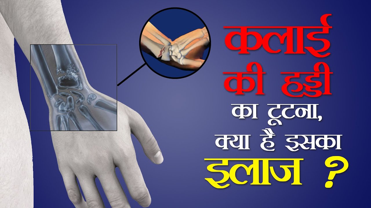 Colles Fracture  I कलाई की हड्डी का टूटना लक्षण और उपचार I Dr Ankit Bhartia