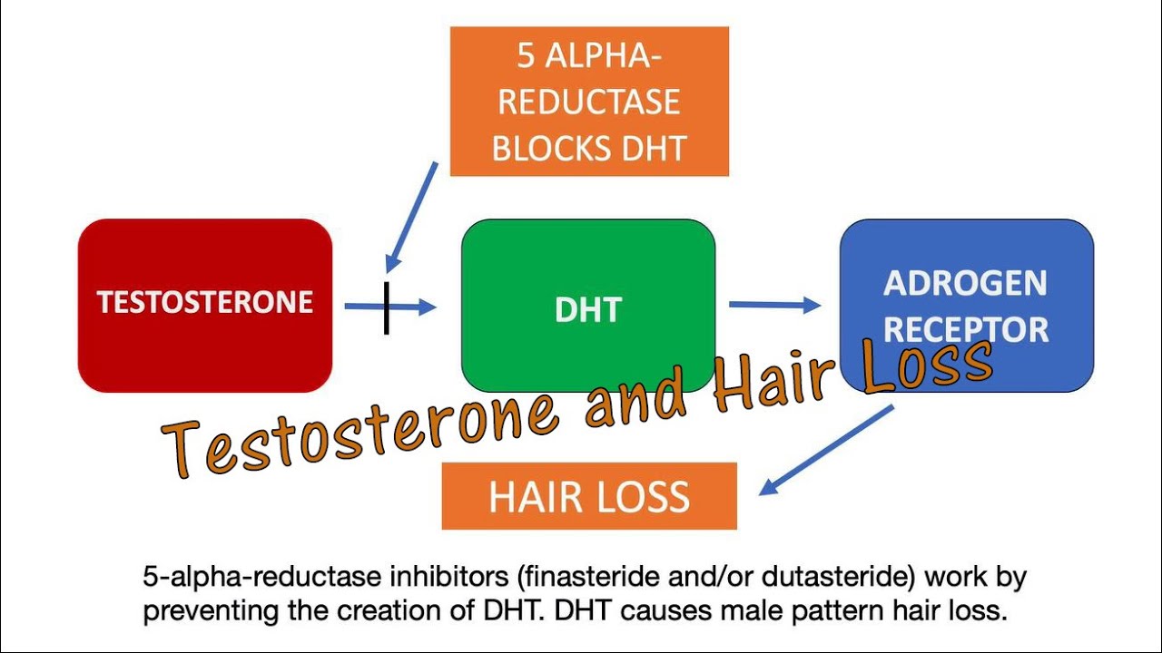 Genetic Hair Loss - It's All About Testosterone