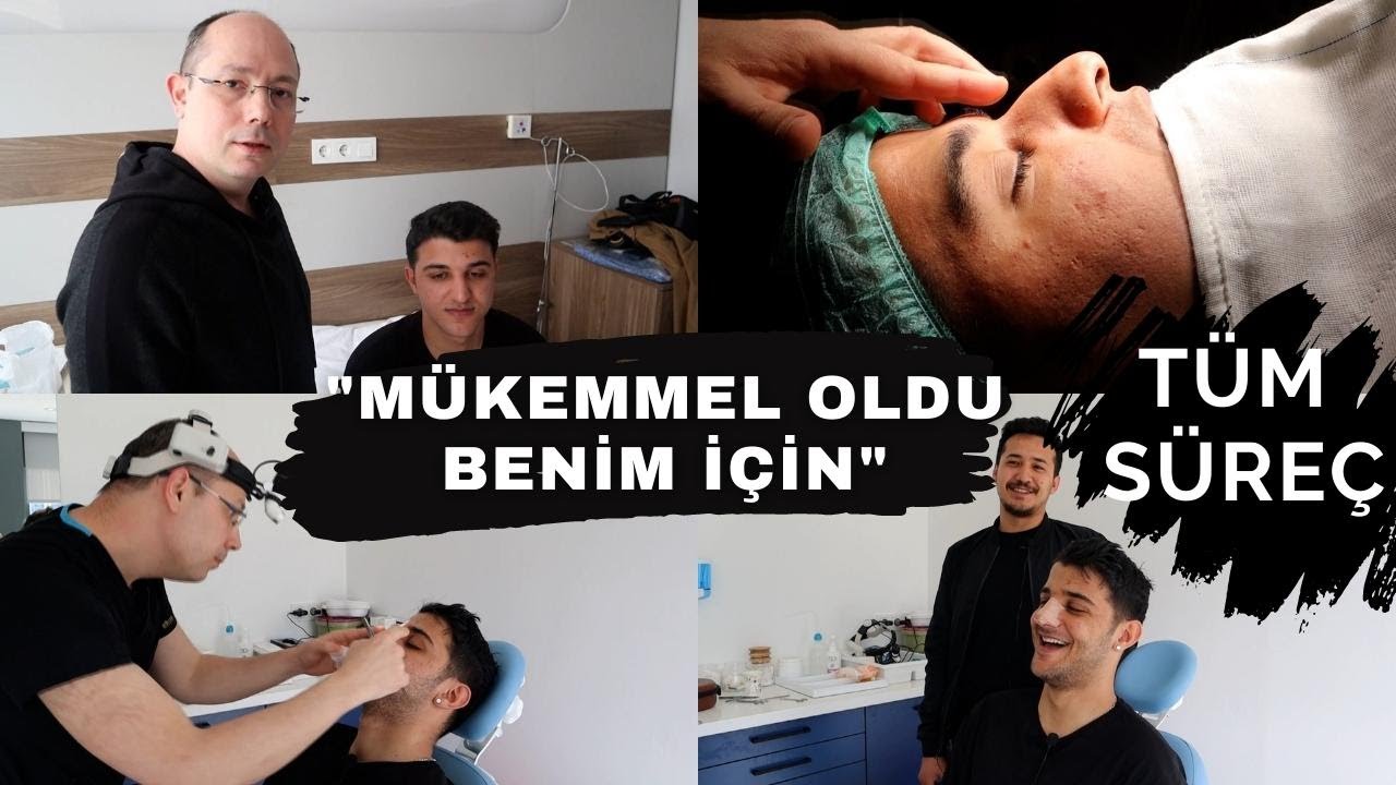 Doğal Erkek Burnu Estetiği | 1. AY SONUCU