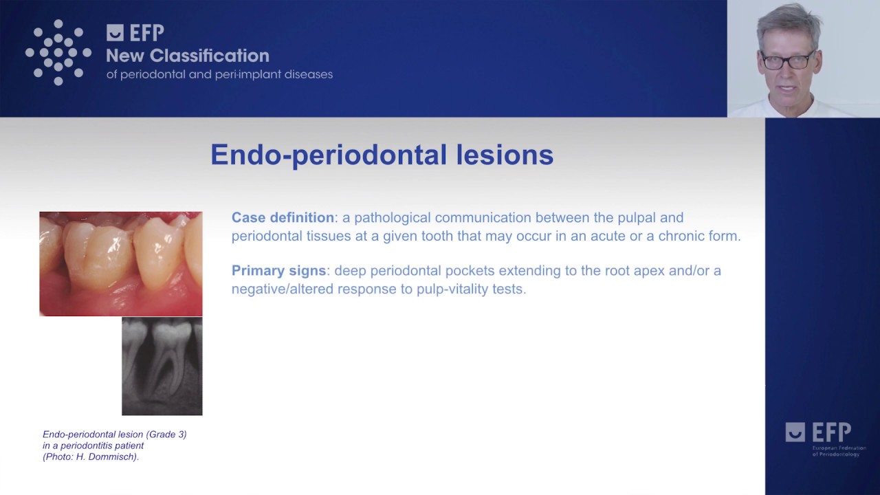 Periodontal abscesses lesions and endo-periodontal lesions - tutorial by Søren Jepsen