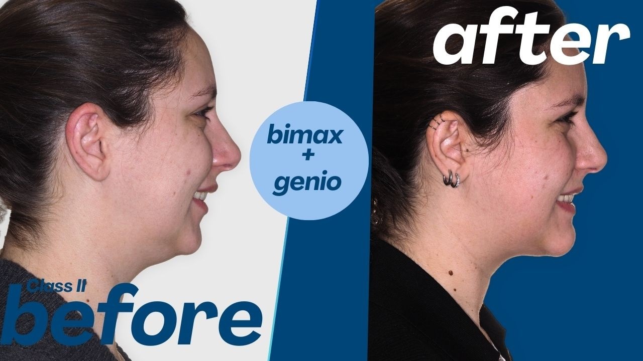 My Jaw Surgery Experience (TMJ Relief & Recovery Story)