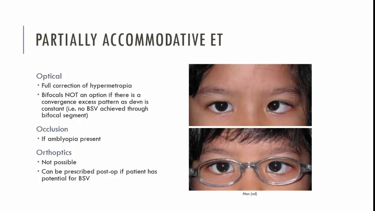 Partially Accommodative ET Management