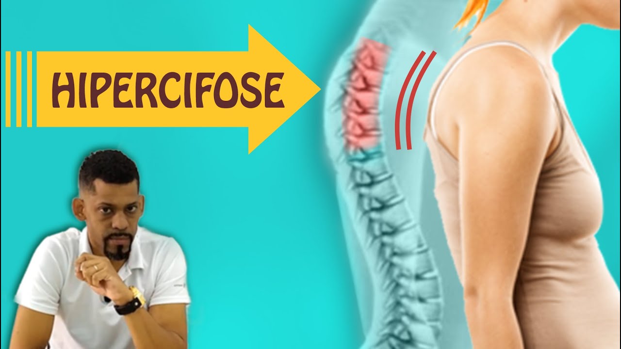 Hipercifose Torácica  - O que é? | Vídeo c/ exercícios p/ EVITAR A CORCUNDA