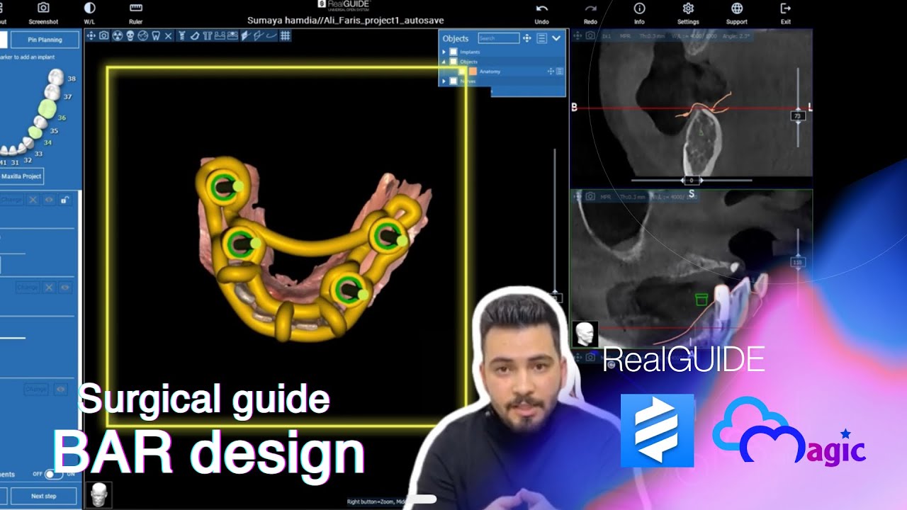 Surgical Guide Bar Design تعلم كيفية تصميم الدليل الجراحي بطريقة مبتكرة
