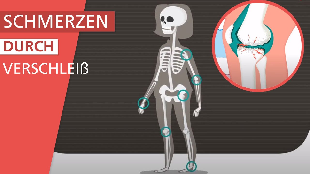 Was ist Arthrose?