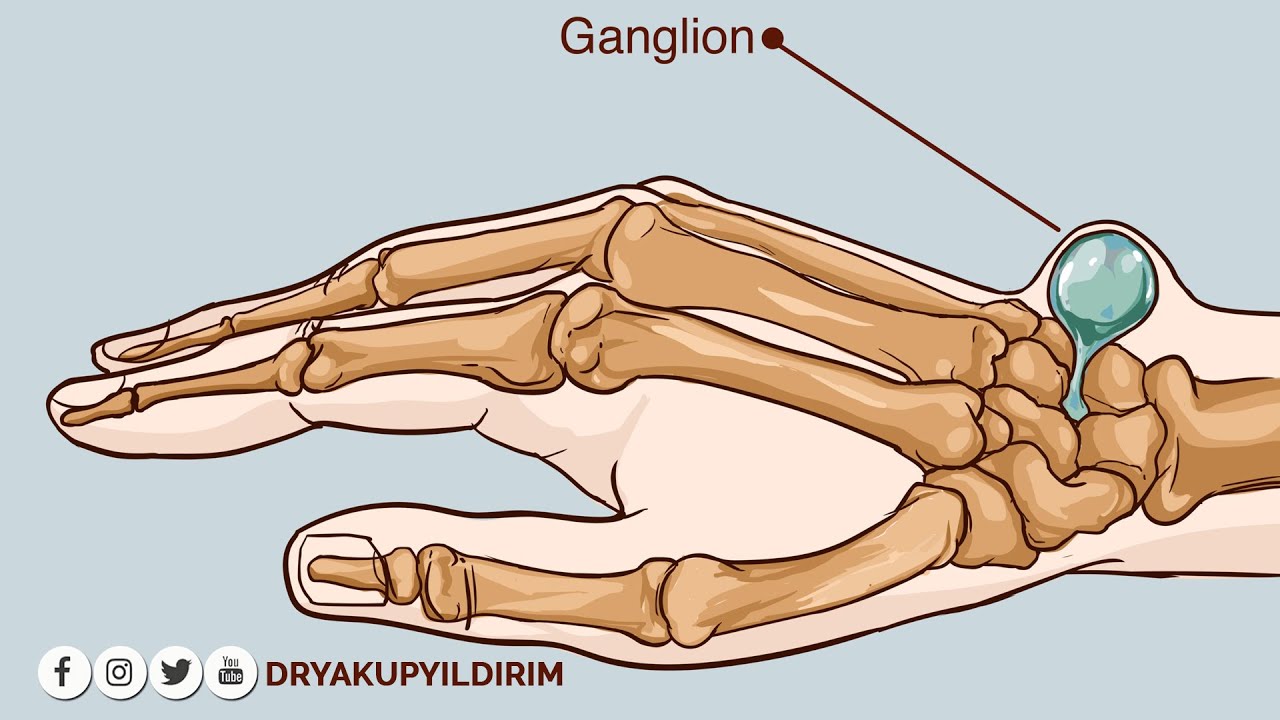 Ganglion (El Bileği) Kisti | Prof. Dr. Yakup YILDIRIM