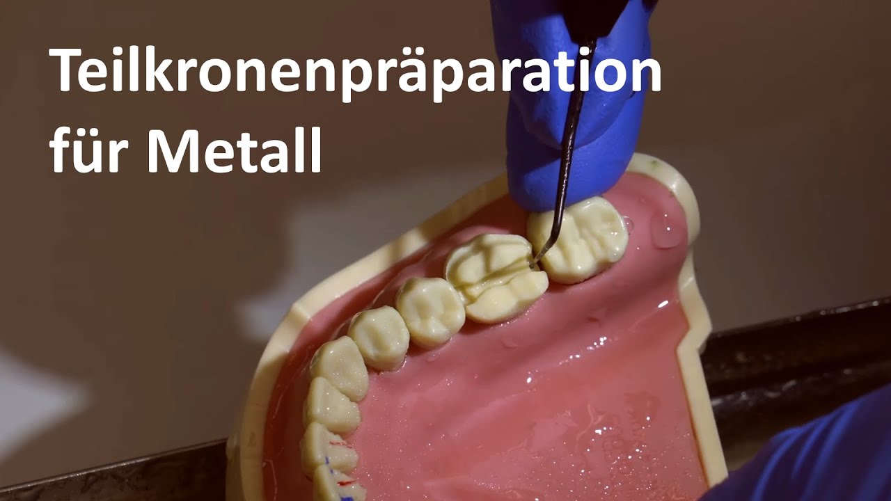 Präparation der Metallteilkrone: Teilkronenpräparationen für Metall [4K]