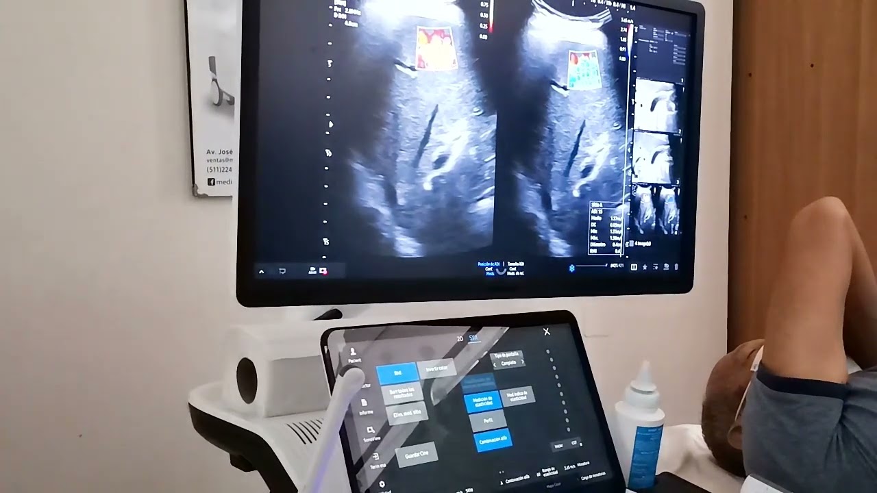 VIDEO DE ELASTOGRAFIA   DOCTOR CARLOS  LÓPEZ.