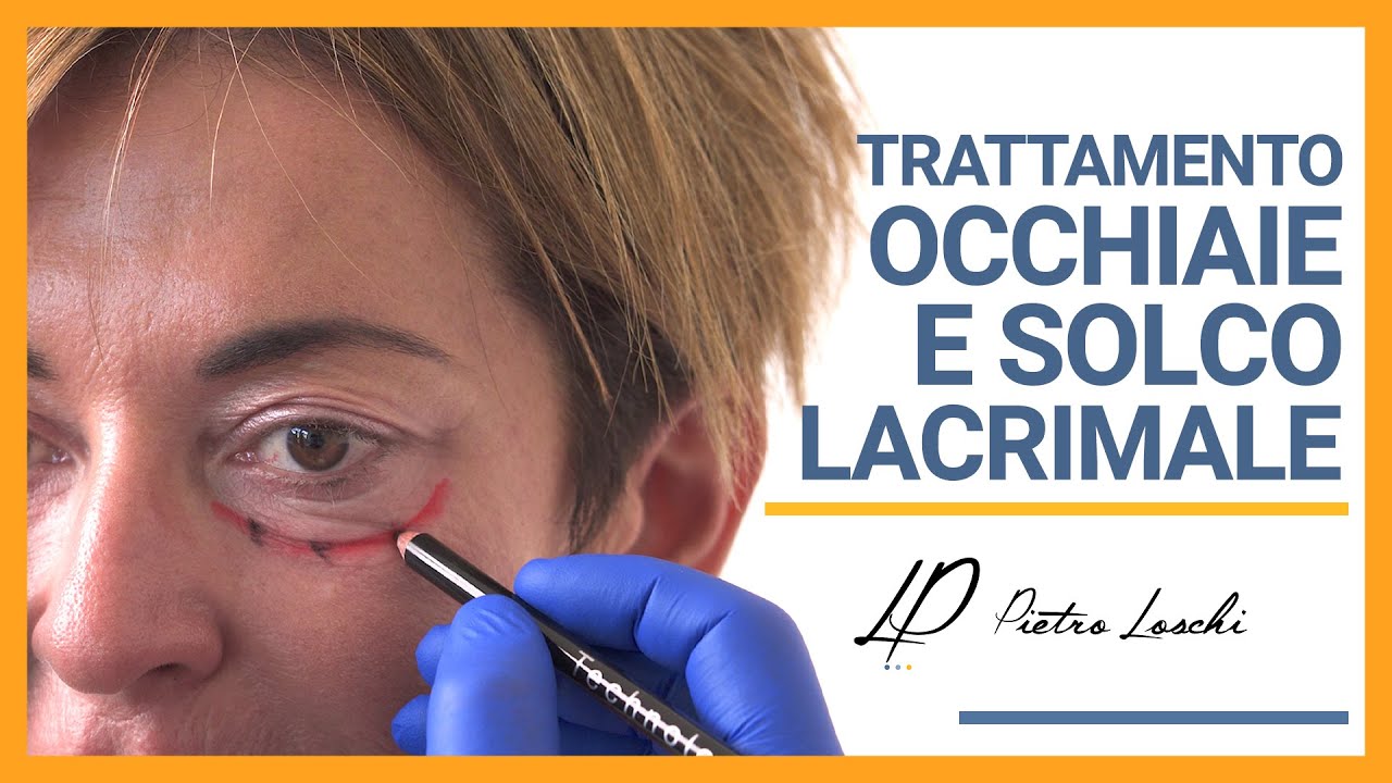 Medicina Estetica: OCCHIAIE e CONTORNO OCCHI - Chirurgo Plastico Modena Bologna Milano