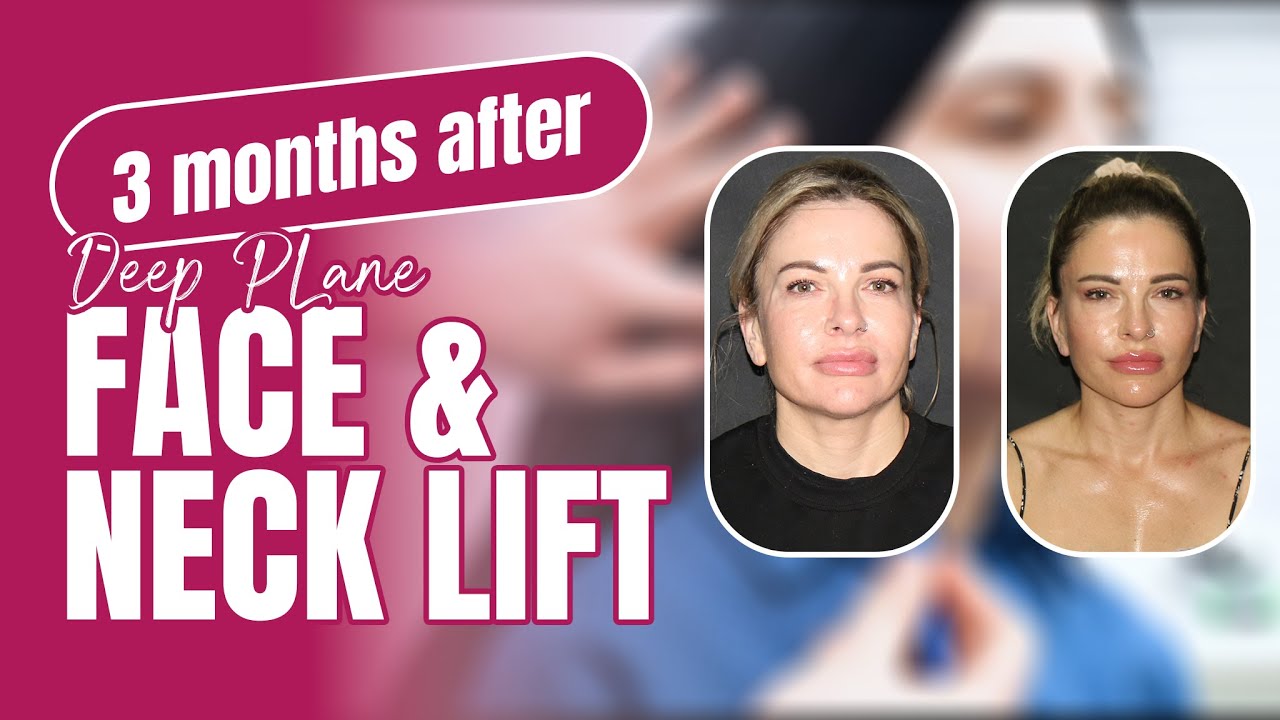 3 Months After Deep Plane Facelift & Temporal Lift in Turkey | Sarah’s Check-Up & Istanbul Tour