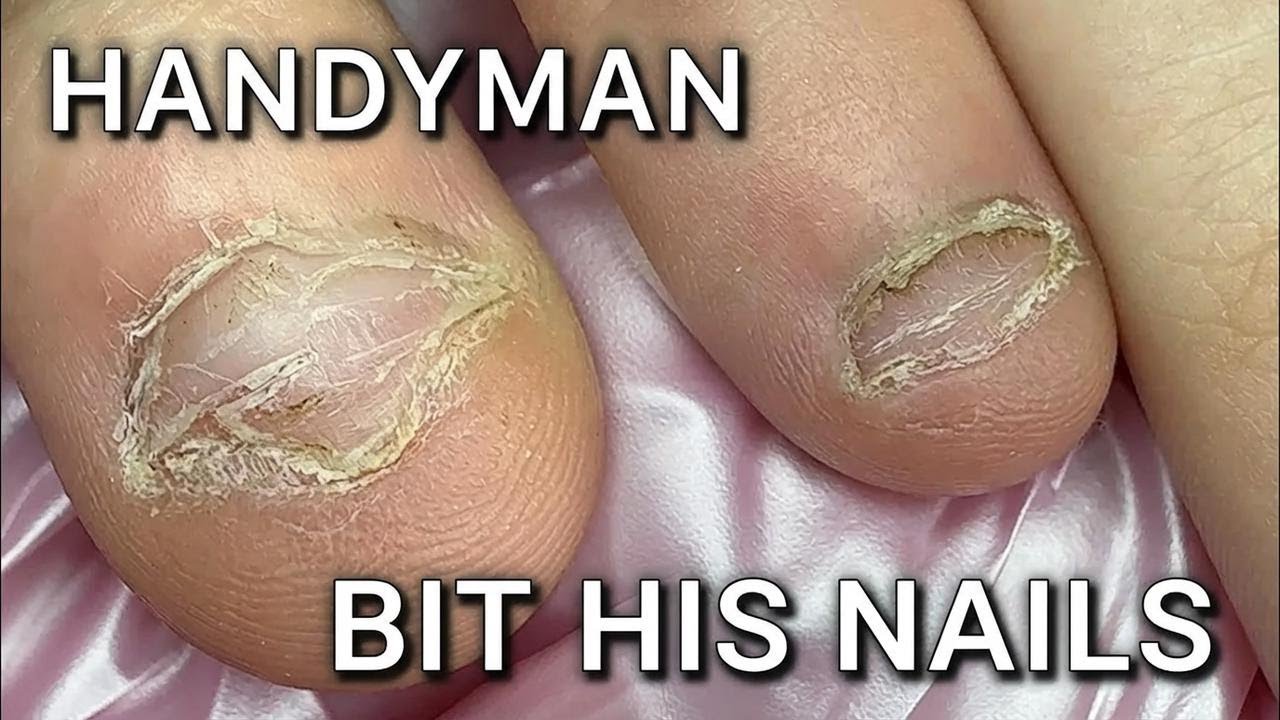 He Ate His Own Nails?! Nail Biting Nightmare & Men's Manicure Transformation