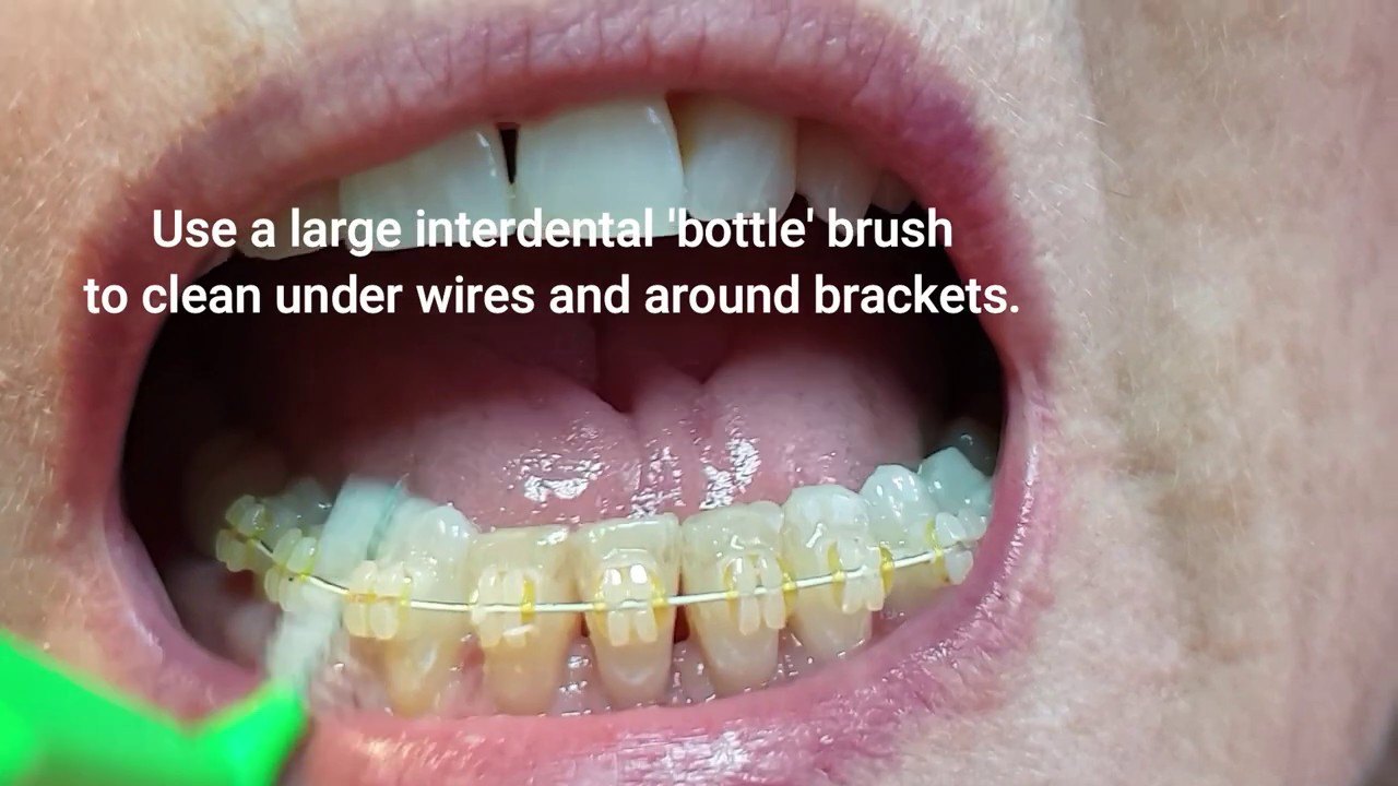 Flossing and Cleaning between teeth with braces/retainers