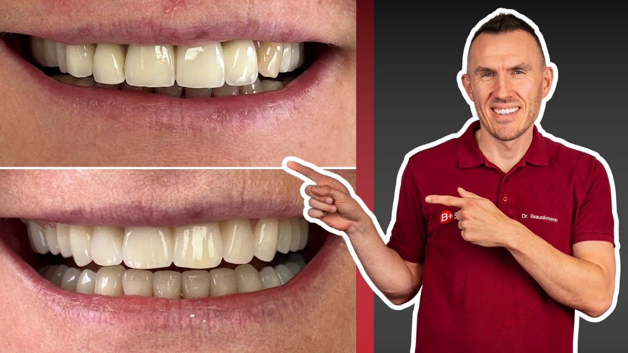 Oberkiefer & Unterkiefer &uuml;berkronen und KOMPLETT versorgen mit Br&uuml;cken, Veneers + Implantat-Br&uuml;cke!