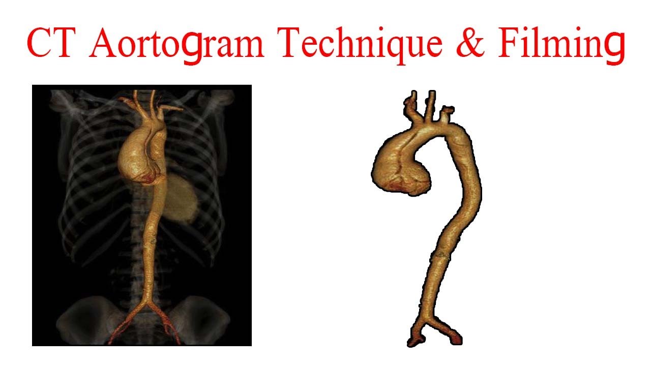 CT Aortogram technique and filming