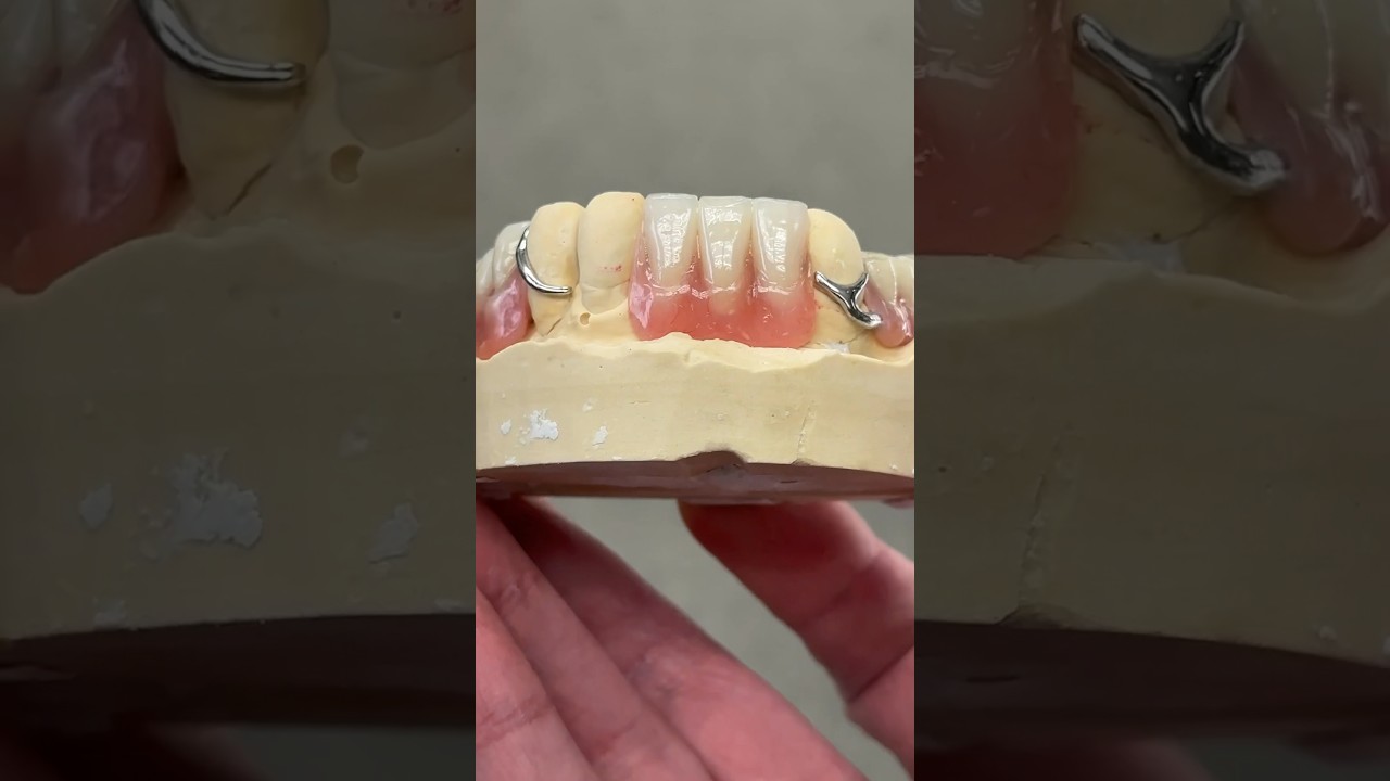 Lower Chrome Cobalt Partial #dental #teeth #smile #lsk121shorts #shortvideo #shorts