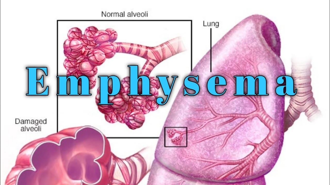 What Is Emphysema? Causes Symptoms & Treatment Explained || Respiratory system diseases || Emphysema