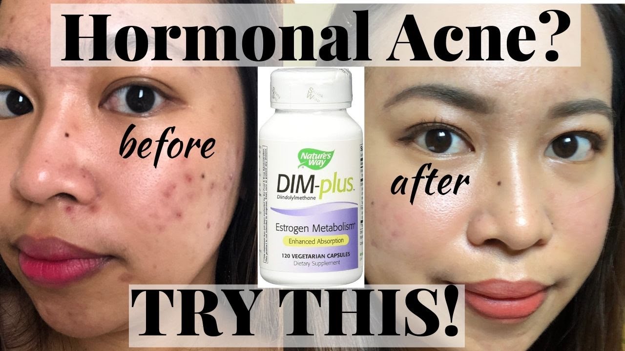 DIM SUPPLEMENT FOR HORMONAL ACNE | EFFECTIVE TALAGA!