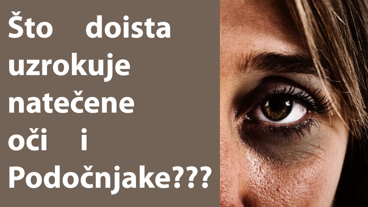 &Scaron;to doista uzrokuje natečene oči i podočnjake Dr#18