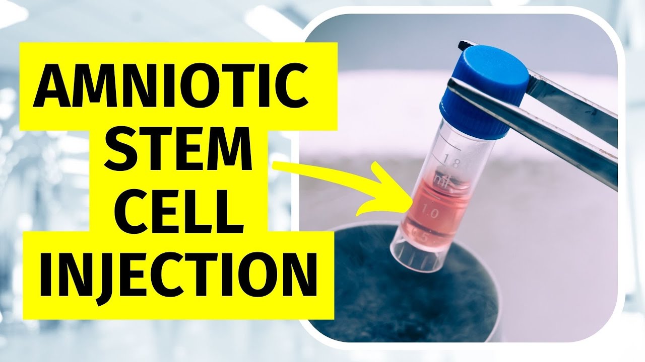 Amniotic Stem Cell Injection for Knee Arthritis