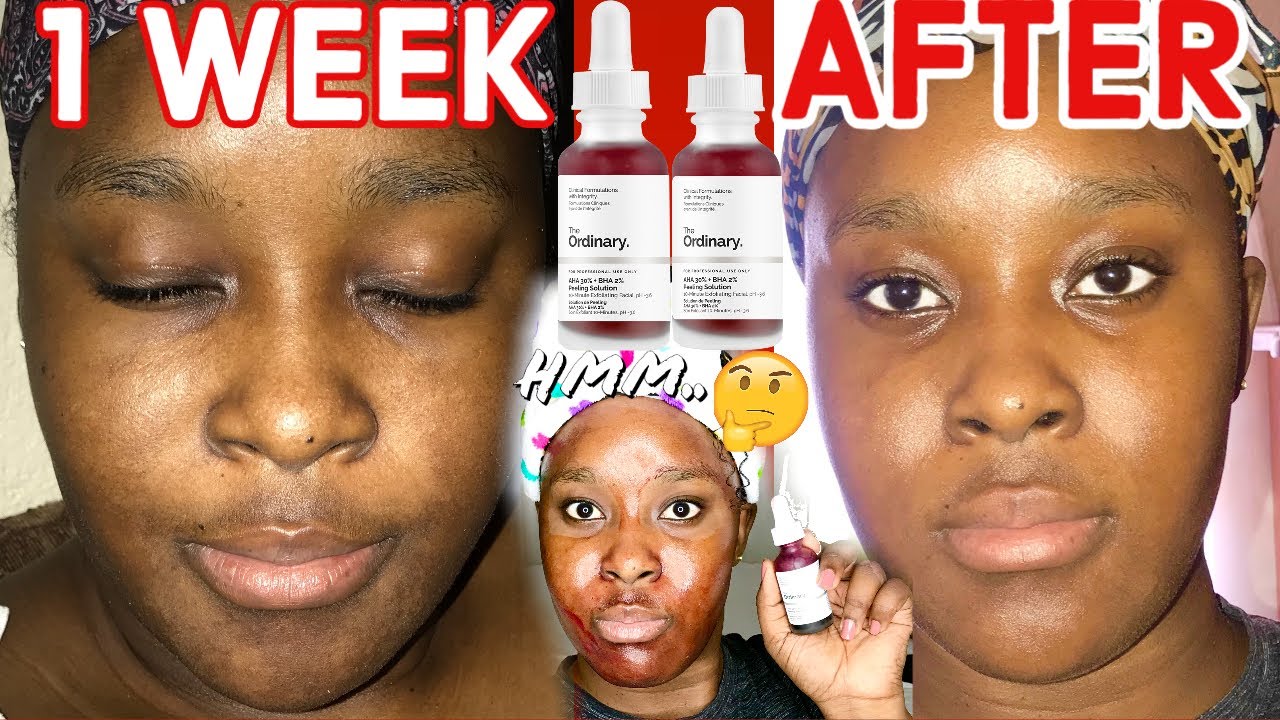Пилинг-раствор The Ordinary AHA 30% BHA 2%! До и после (1 неделя) | Как использовать и как наносить!