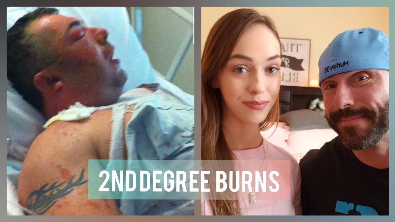 Reece Burnt His Face Off  | Story Time