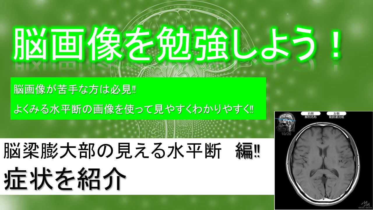 無料で簡単！脳画像の勉強「脳梁膨大部の見える　水平断編　症状紹介」【超簡単解説】