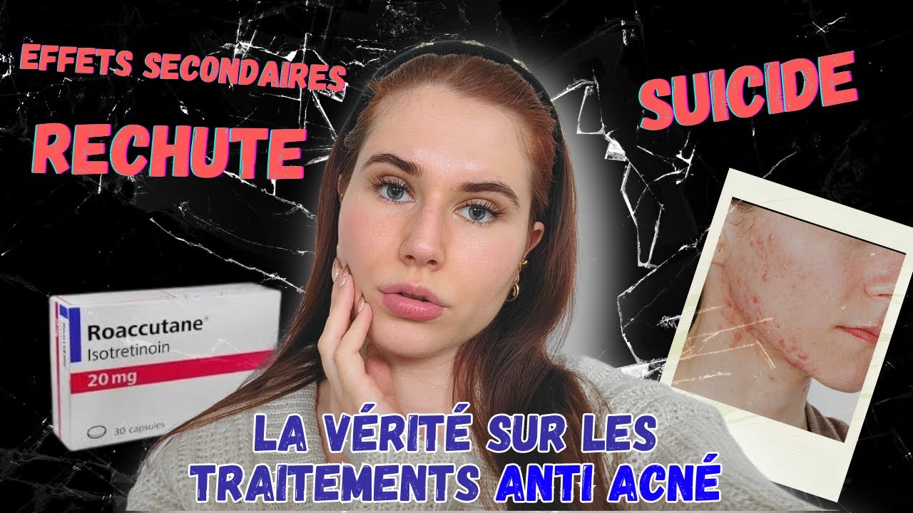 Roaccutane, Curacné : le traitement controversé qui a soigné mon acné.