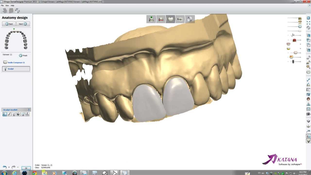 How to design Digital Veneers in 3Shape (1)