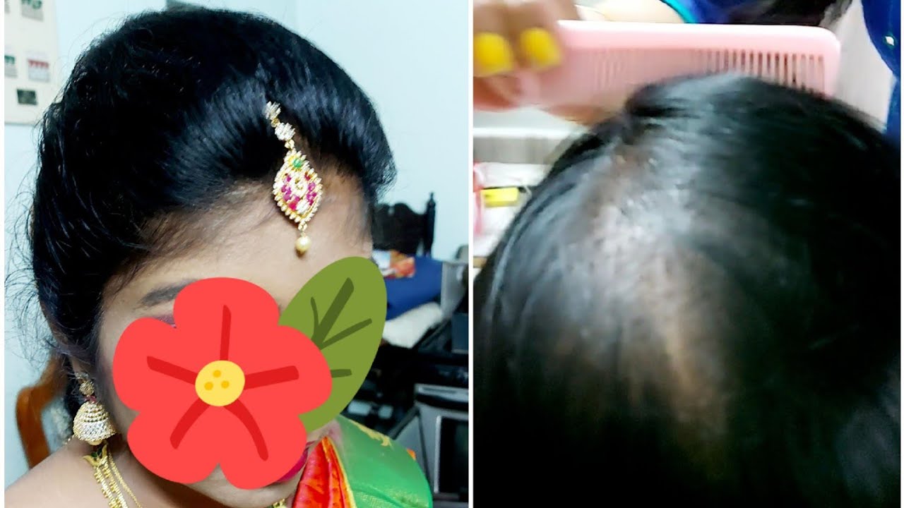 Puff Hairstyle//FrontPuff//How To Hide BALDNESS//PUFF Hairstyle For THINHAIR//Fix Hair Extensions