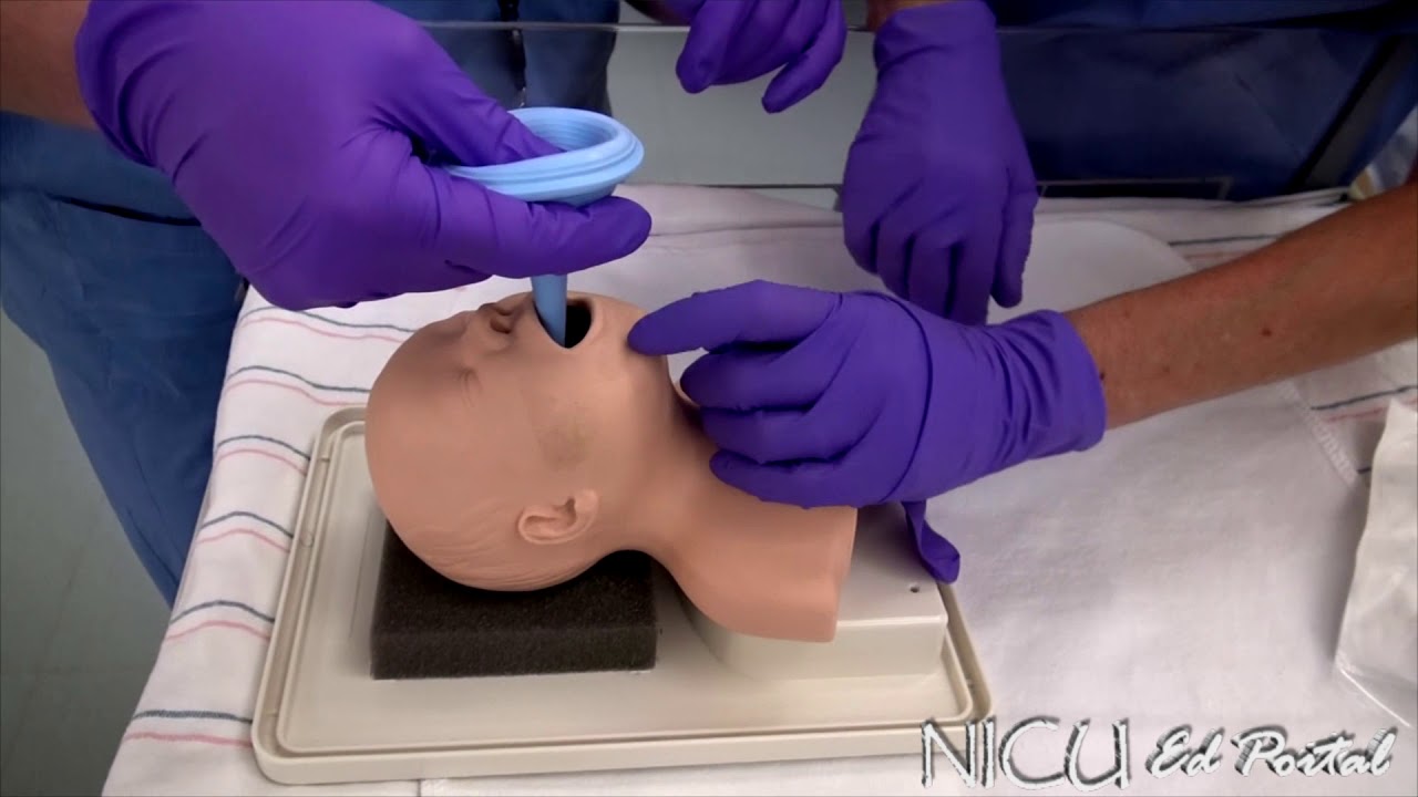 Bulb suctioning technique