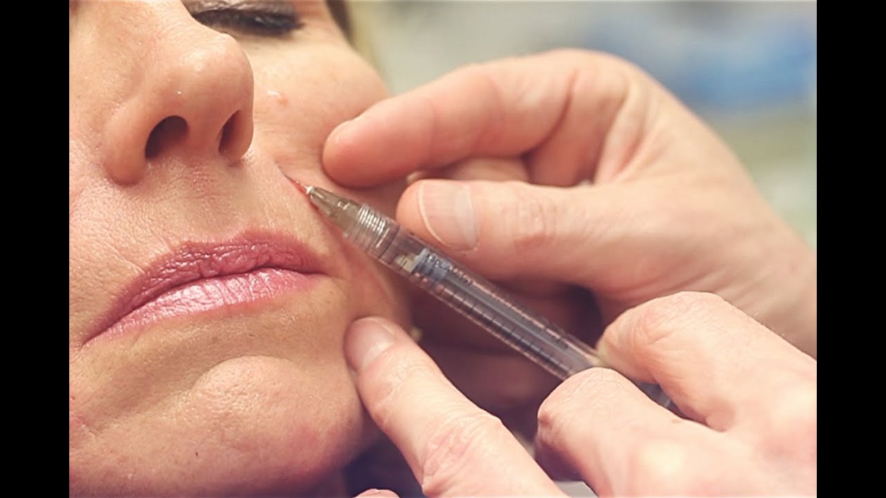 This Is Beauty | Dermal Fillers | For Frown and Laugh Lines