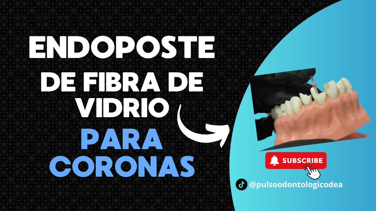 PASO A PASO | Colocaci&oacute;n de ENDOPOSTE de Fibra de Vidrio