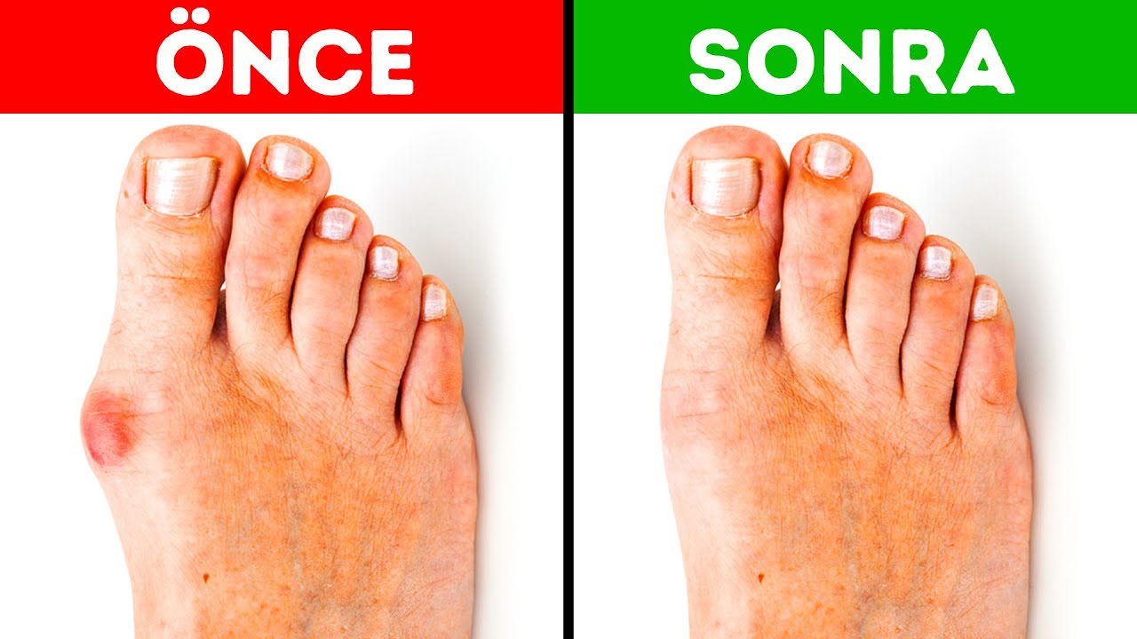 Bunyonlardan Kurtulmanın 5 Etkili Yolu