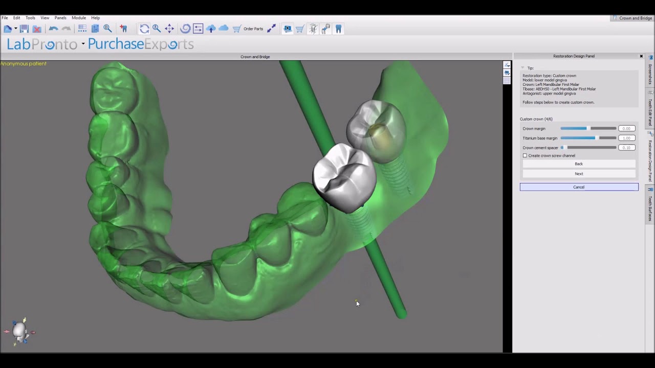 Blue Sky Plan: Fabricating Crowns for Titanium Base Abutments