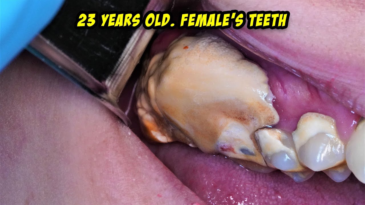 Another Giant Tartar | Scaling | Dentist | Dokter Gigi Tri Putra
