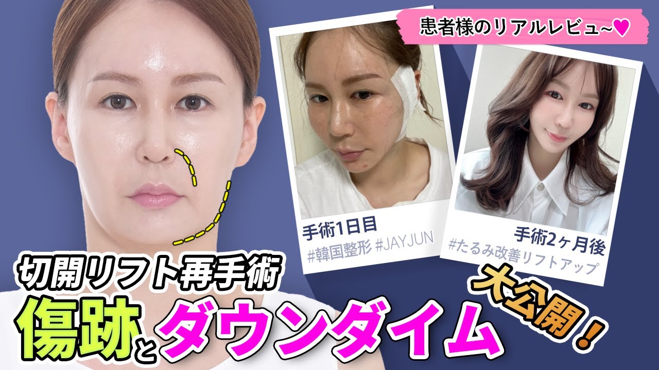 【韓国症例】★ついに切開フェイスリフト再手術を★手術前から手術後までリアルなダウンタイムのプロセスをお見せします👏