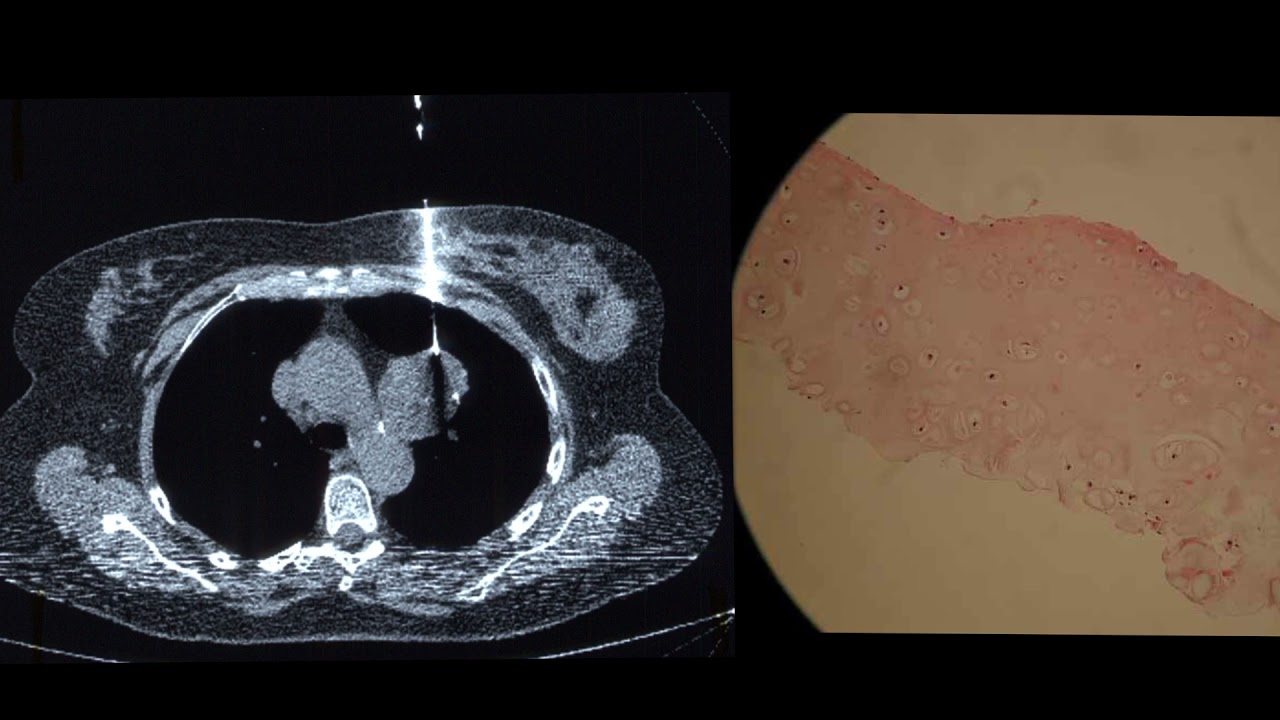Pulmonary hamartoma a benign chest mass