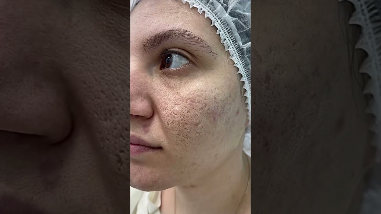 PRP+Microneedling treatment          #viral #skincare #viralvideo #shorts