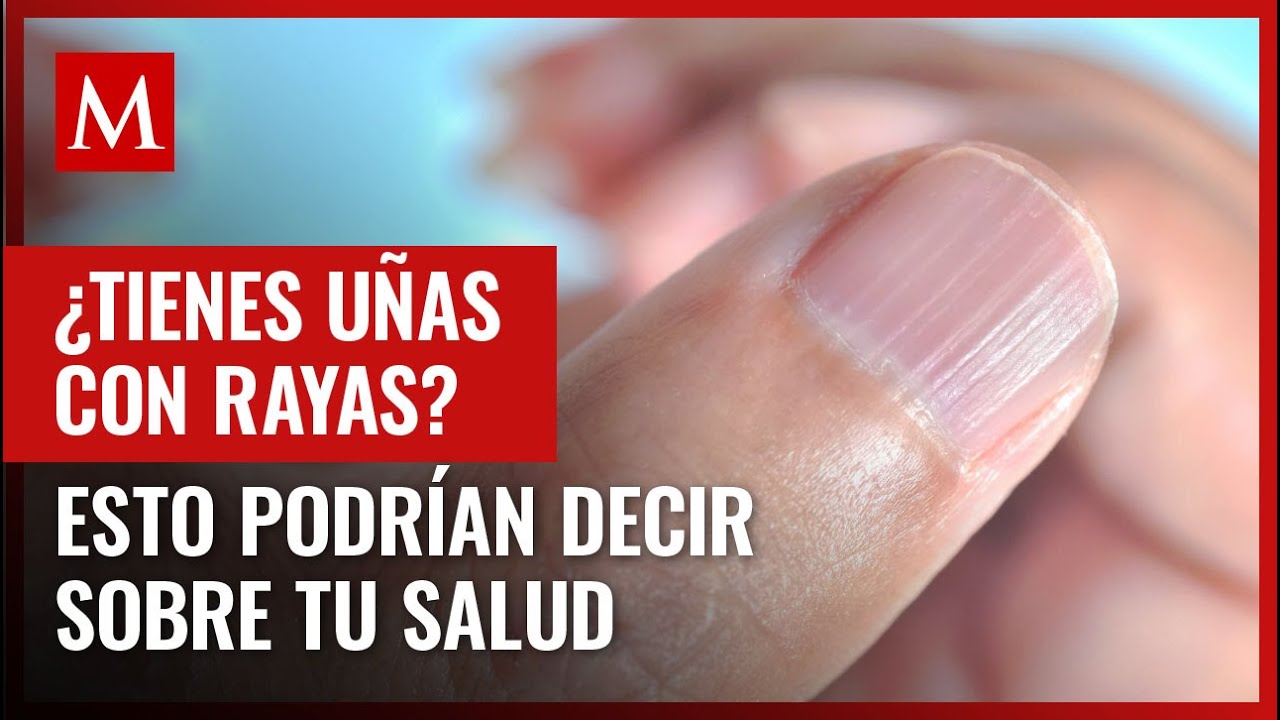Las rayas en las uñas podrían ser un indicativo de algunas condiciones médicas; te contamos cuáles