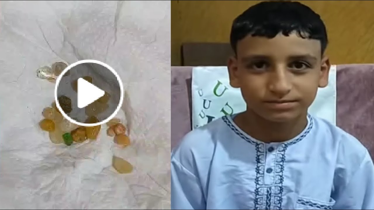 اول ظهور للطفل المعجزة يتبول أحجار كريمة.. شوف بنفسك عاطف المعجزة بيعمل إيه في كفر الشيخ