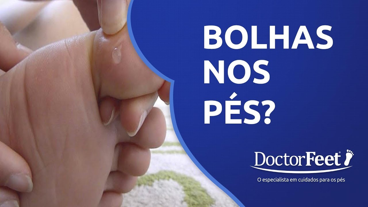 BOLHAS NOS PÉS? O que fazer para TRATAR e como CURAR #3