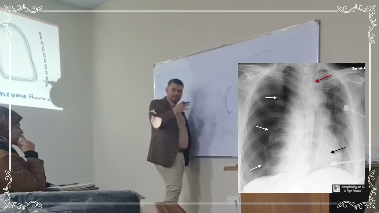 الانبوب الصدري | Chest Tube Management