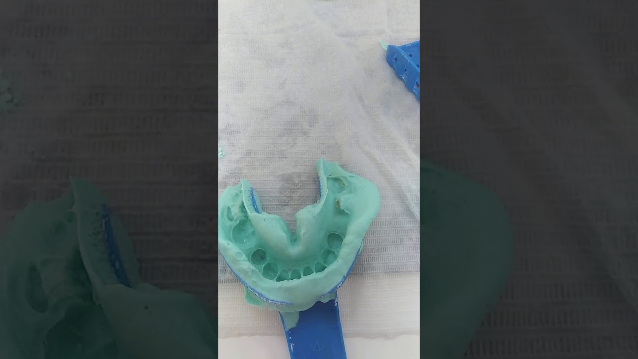 Visit 1: Partial impression by alginate. Reasons of mistakes and corrections