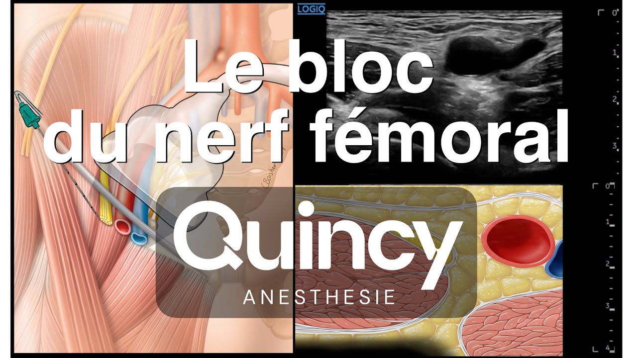 Bloc du nerf fémoral : technique et anatomie - 2025