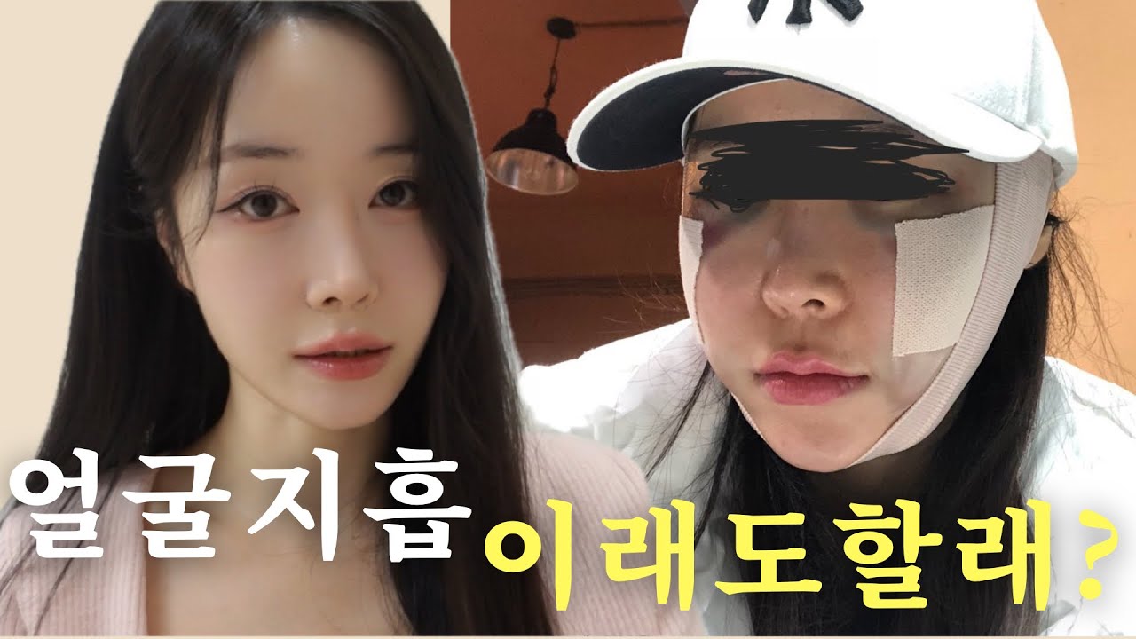 얼굴살,볼살 한방에 해결? 얼굴 지방흡입 단점 솔직하게 알려드릴게요..