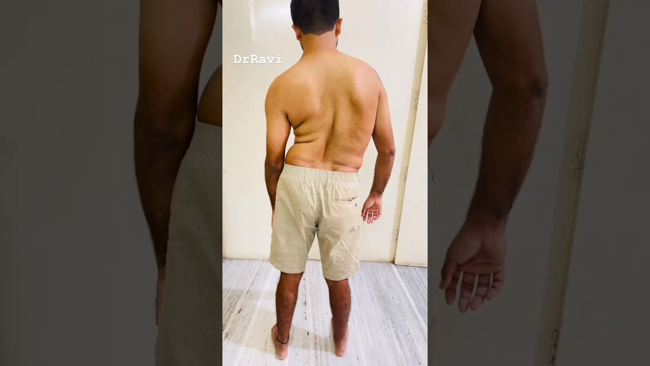 Scoliosis treatment #scoliosistreatment #scoliosisawareness #spine #chiropractic #physio #kyphosis