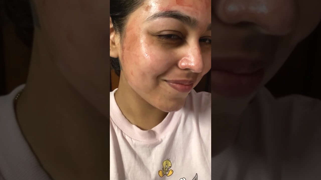 Started using the ordinary AHA BHA peeling solution. Have been using it for 3 weeks now #ashortaday